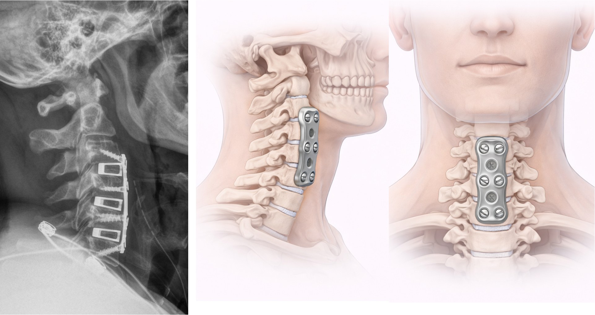 Post-operative ACDF X-ray
