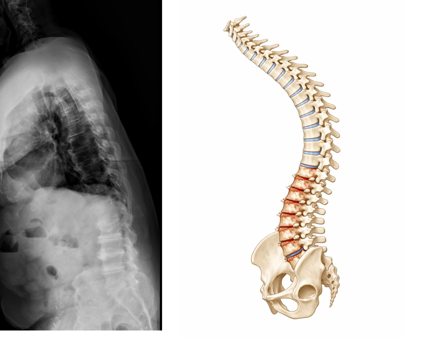 Flatback deformity imaging