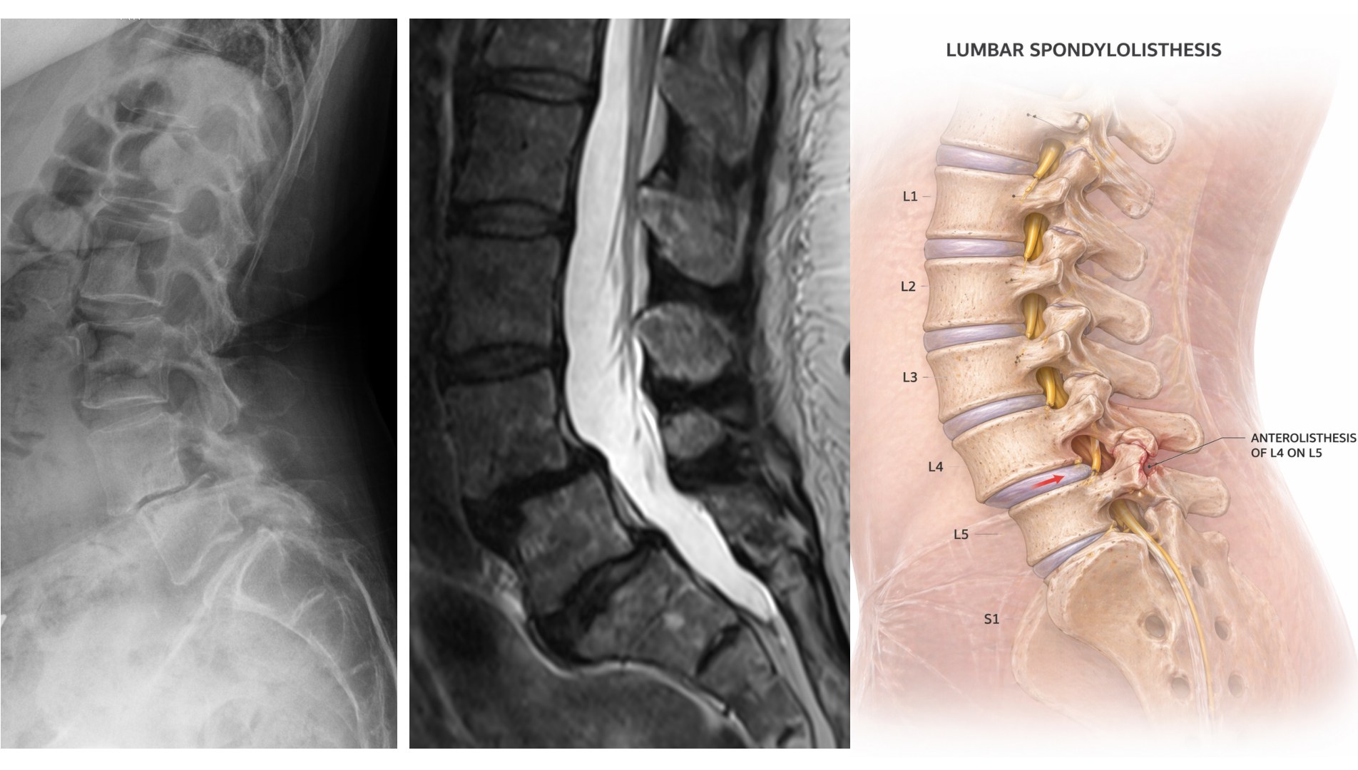 Lumbar spondylolisthesis