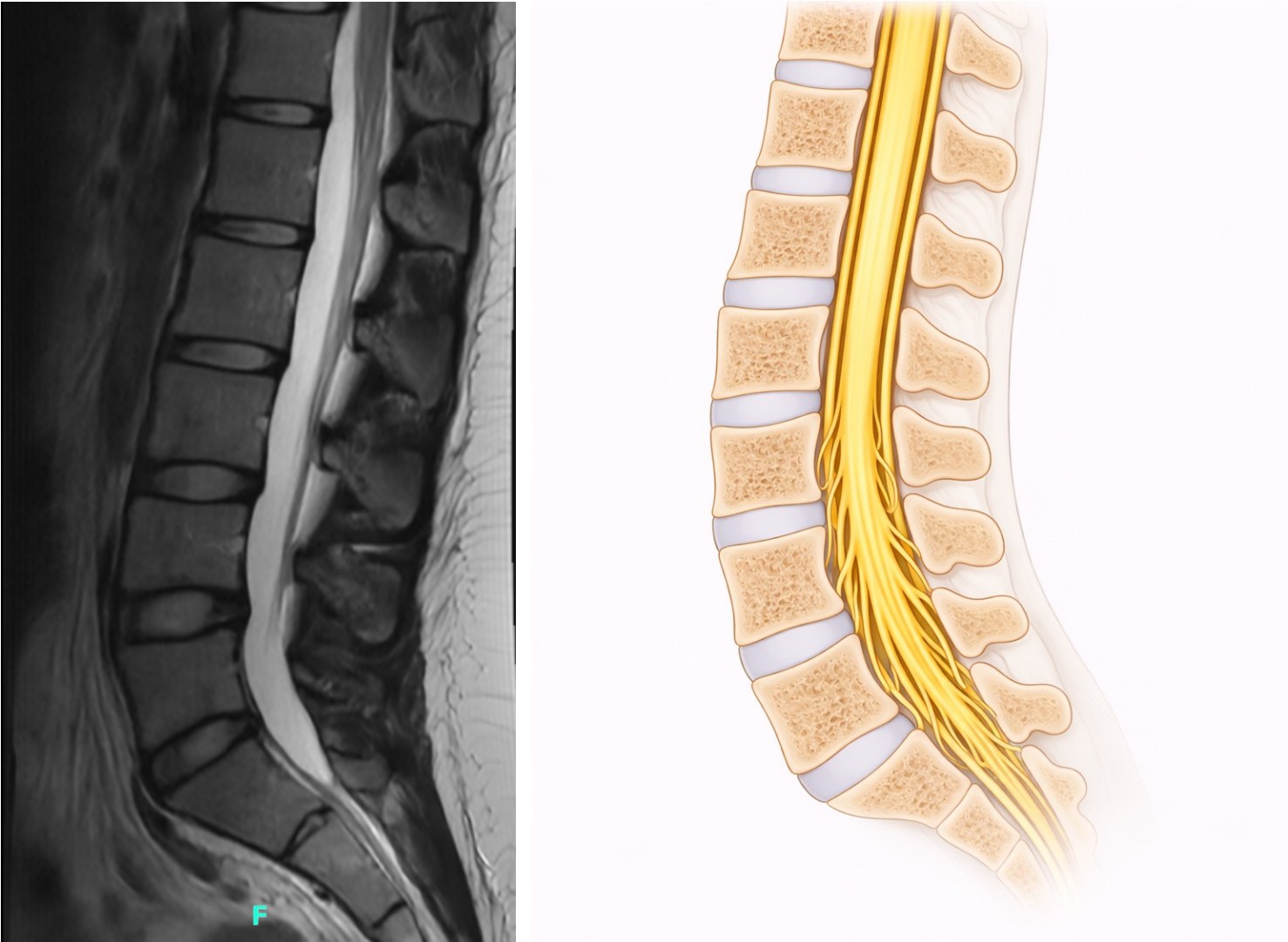 Normal lumbar spine MRI