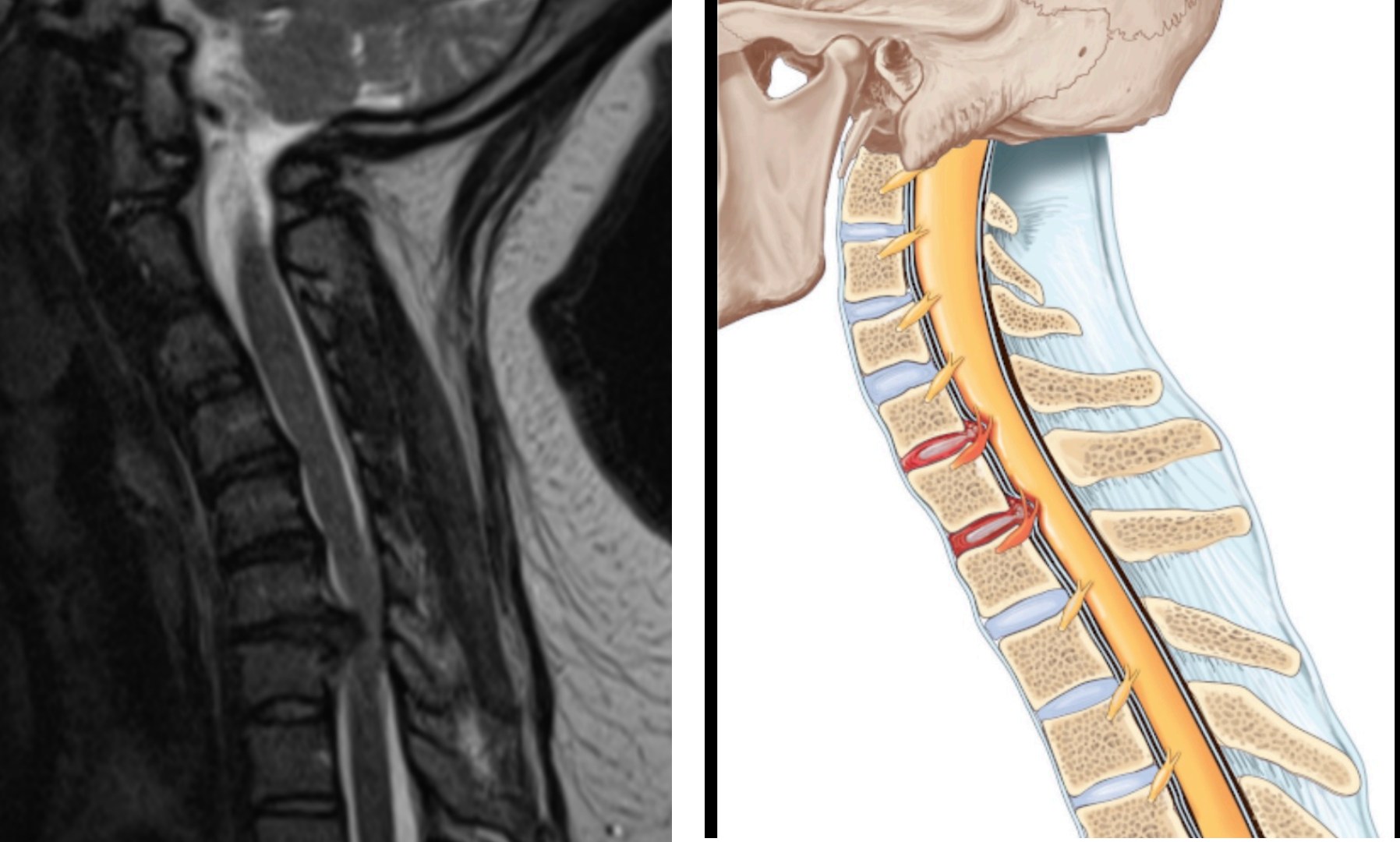 Cervical disc herniation