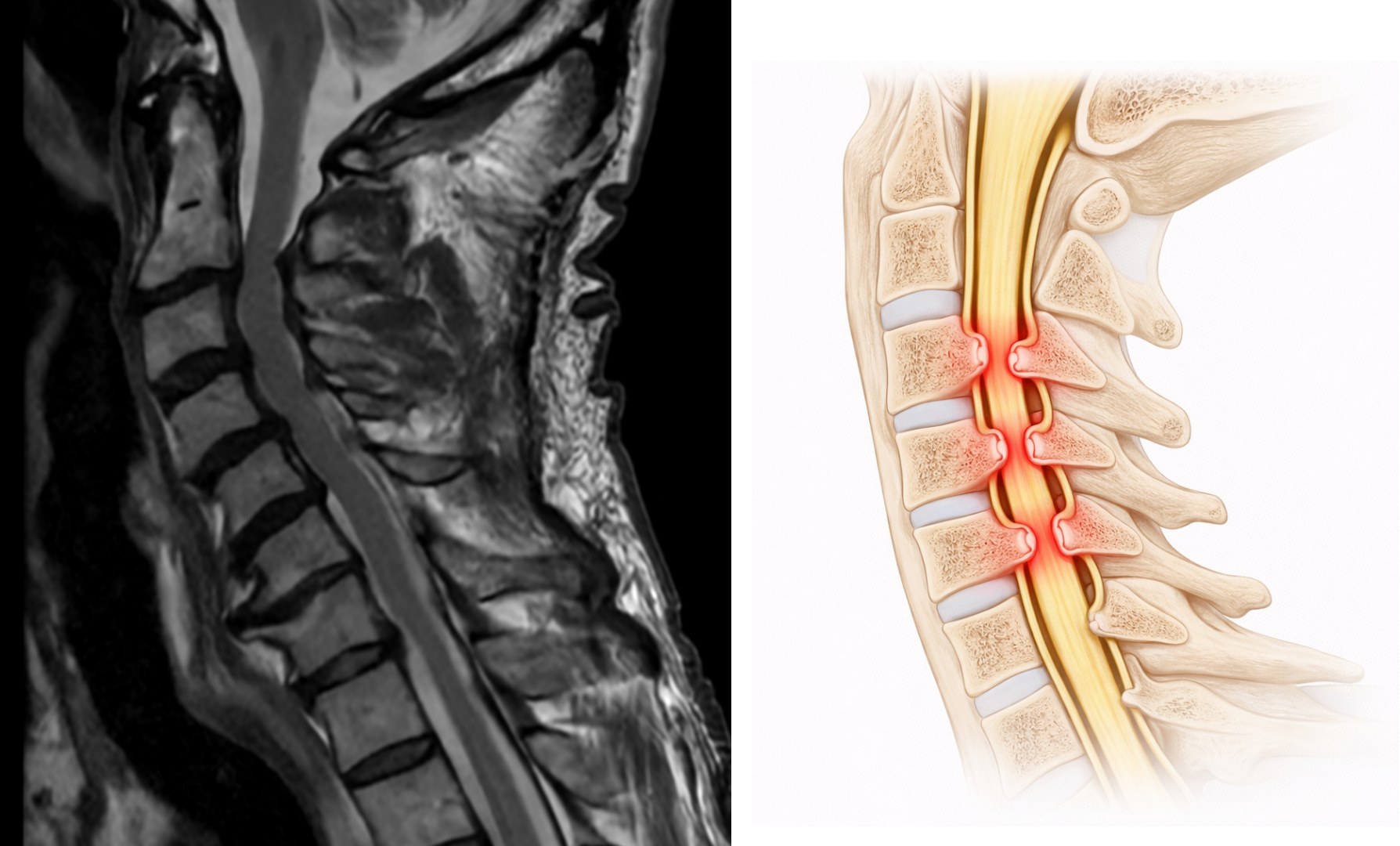 Cervical stenosis MRI